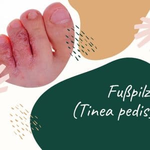 Fußpilz - infektiöse Hauterkrankung durch indirekte Übertragung per Kontakt- oder Schmierinfektion