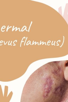 Feuermal - gutartige Hautveränderung und häufigste Gefäßfehlbildung bei Neugeborenen