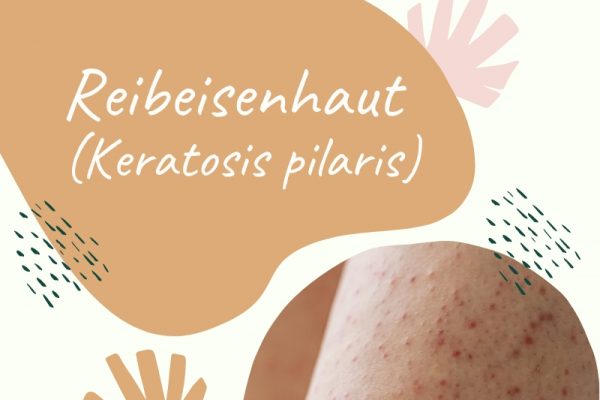 Keratosis pilaris - harmlose Hauterkrankung und genetisch bedingte Verhornungsstörung